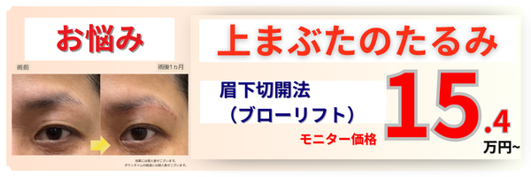 眉下切開・ブローリフト