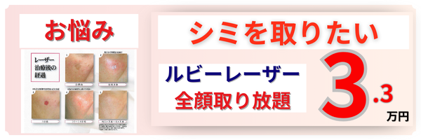 ルビーレーザー・シミ取り放題・シミ取りレーザー