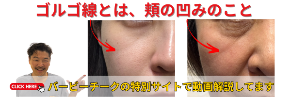 バービーチークによる中顔面短縮を解説｜ゴルゴ線改善症例をもとにバービーチークを徹底解説